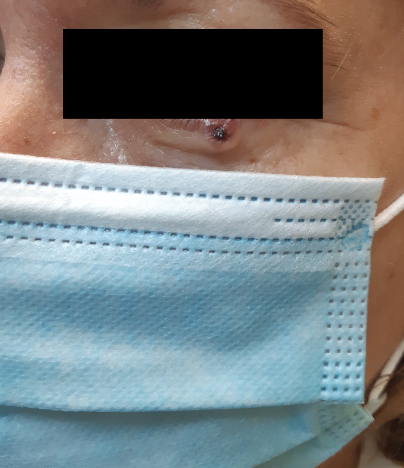 Cirugía de Mohs con control microscópico  y reconstrucción