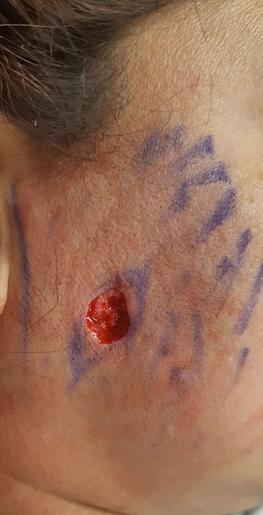 Before: Cirugía de Mohs con control microscópico  y reconstrucción