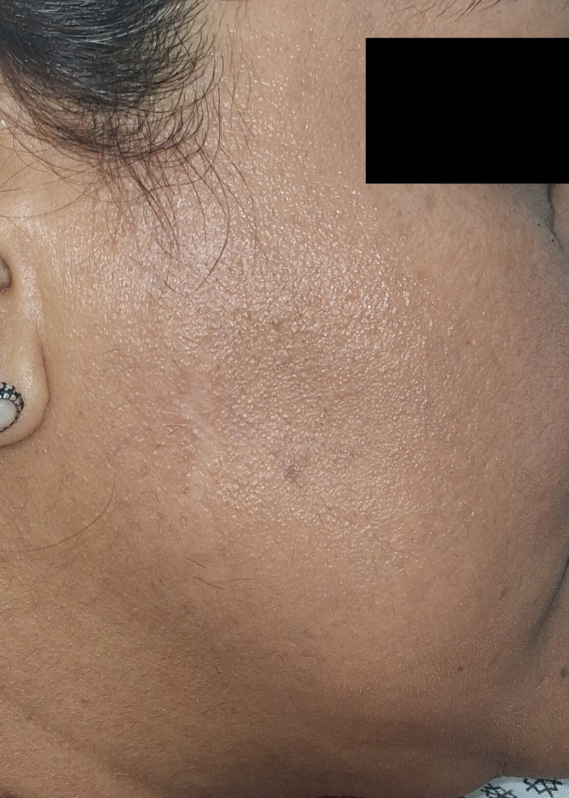After: Cirugía de Mohs con control microscópico  y reconstrucción