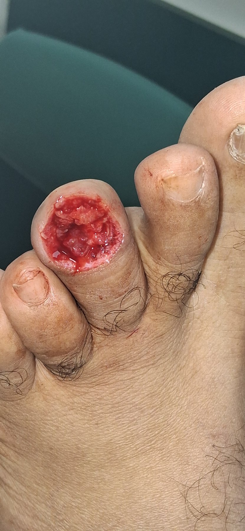 Before: Tumor Agresivo