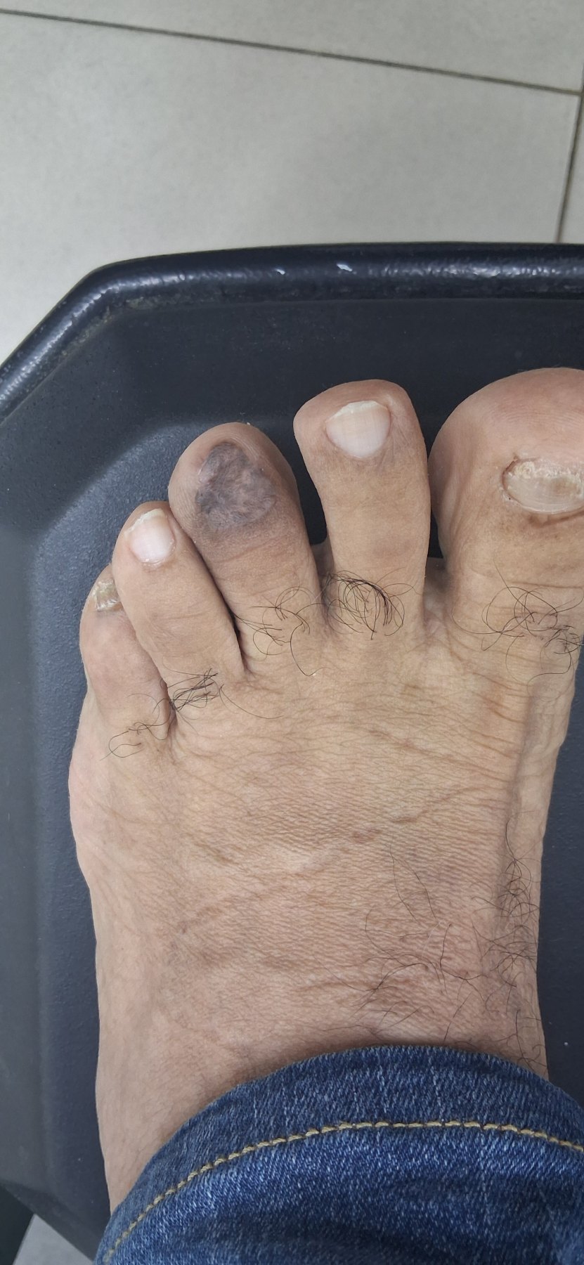 After: Tumor Agresivo