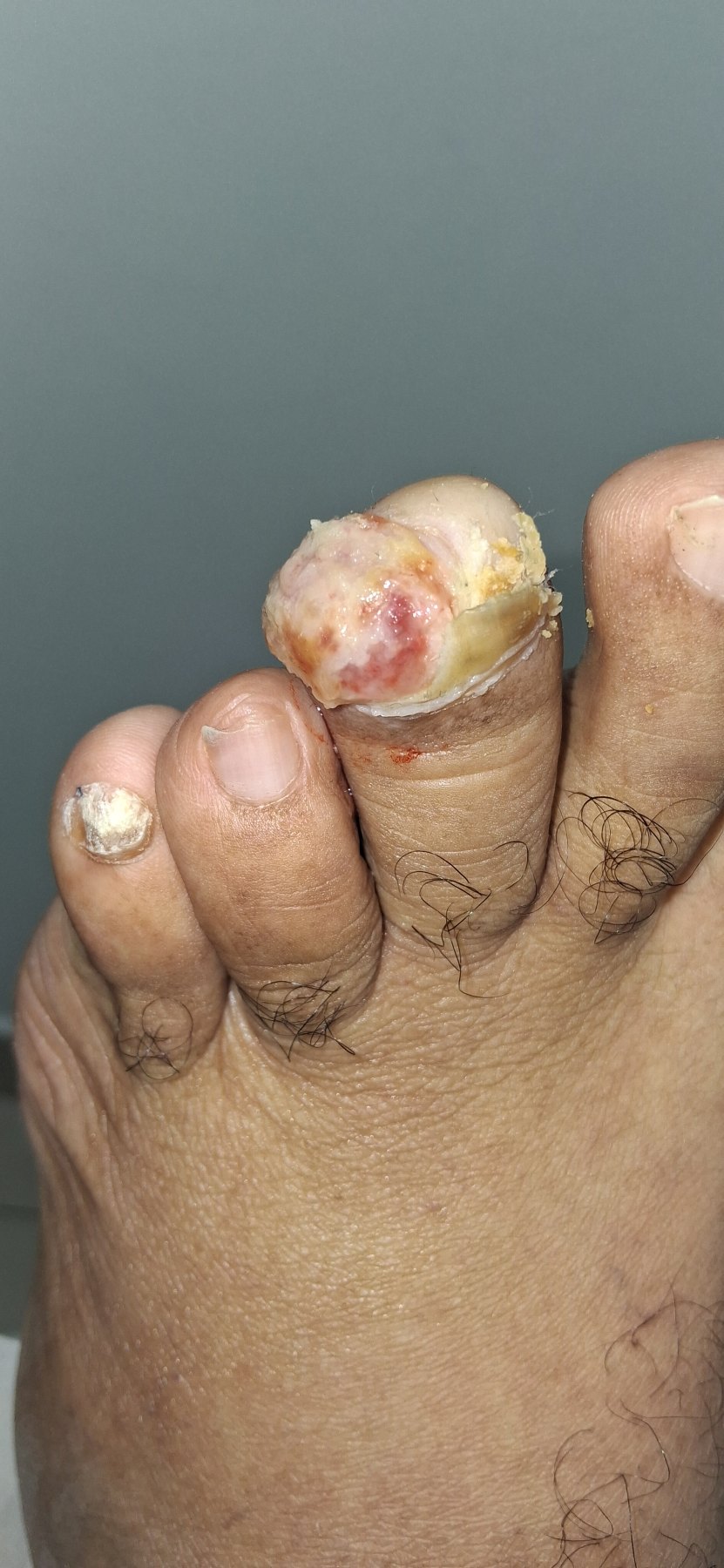 Tumor Agresivo