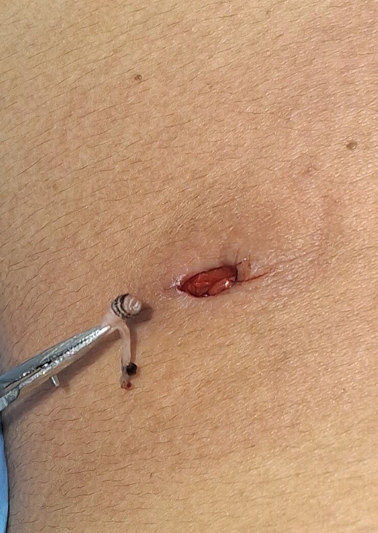 Before: Miasis Cutánea ( Larva )