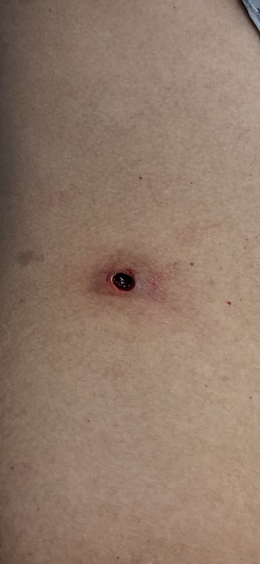 After: Miasis Cutánea ( Larva )