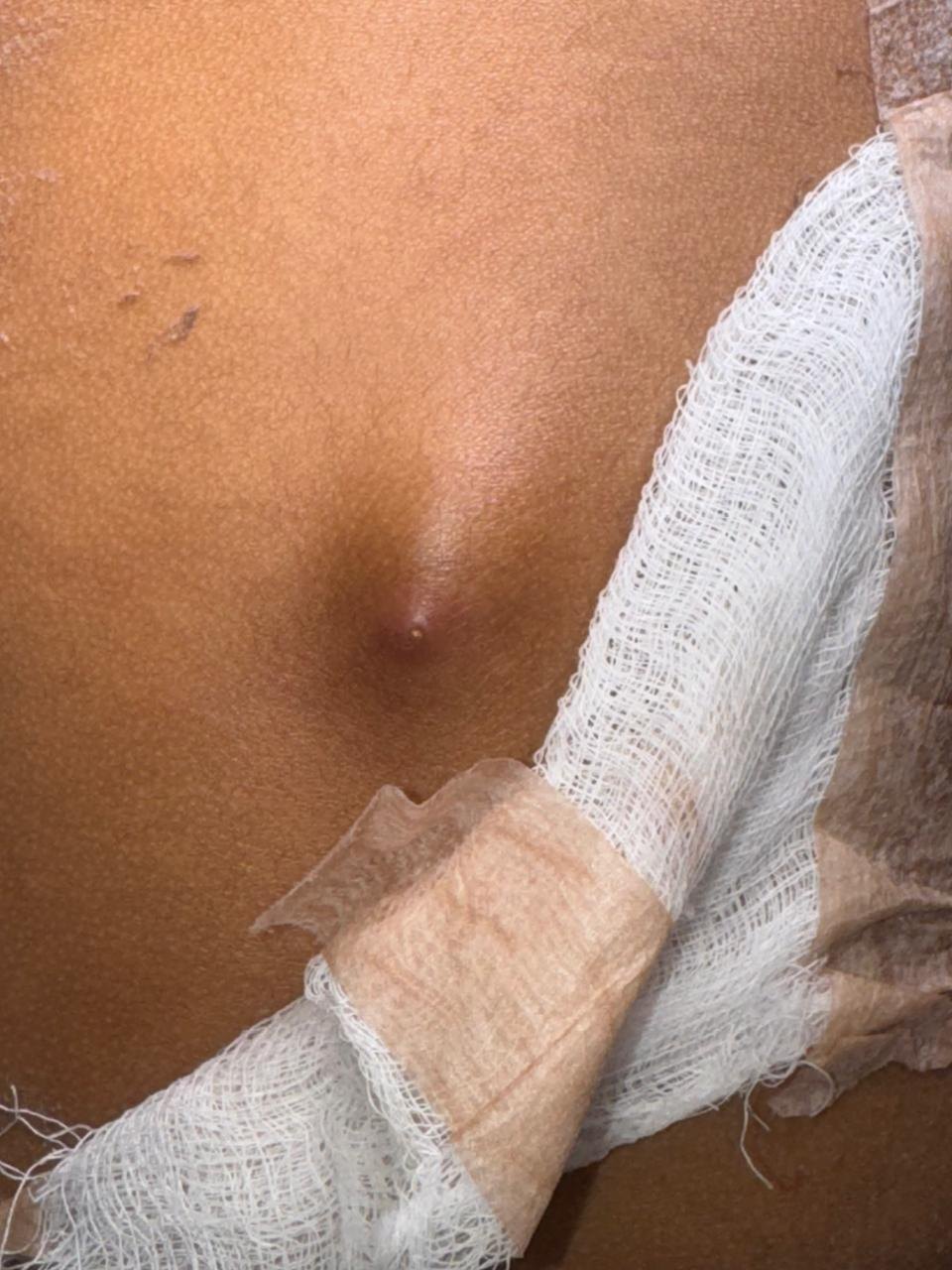 Before: Miasis Cutánea ( Larva )