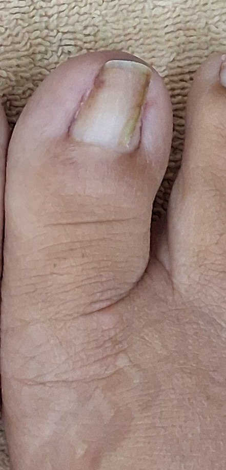 After: Uña encarnada