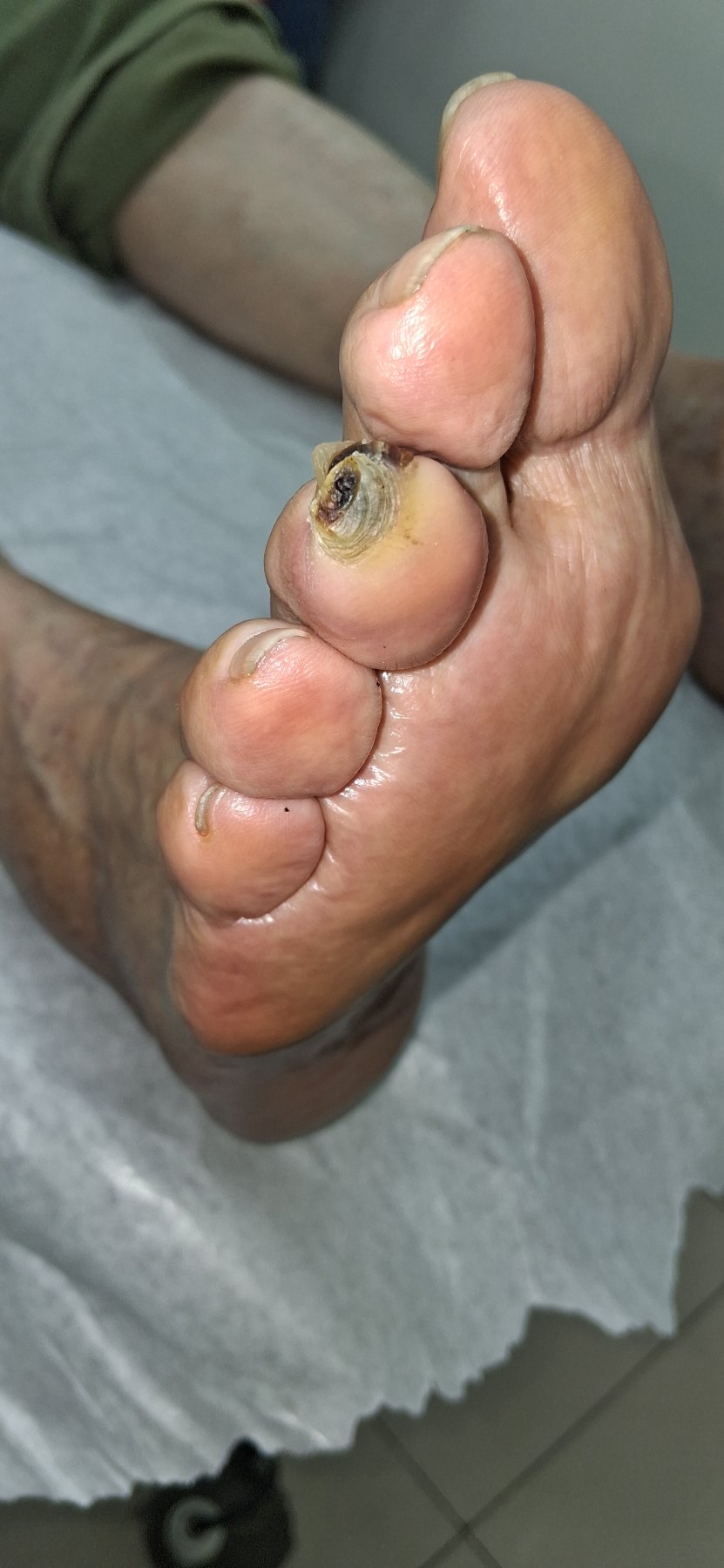 Before: Callo