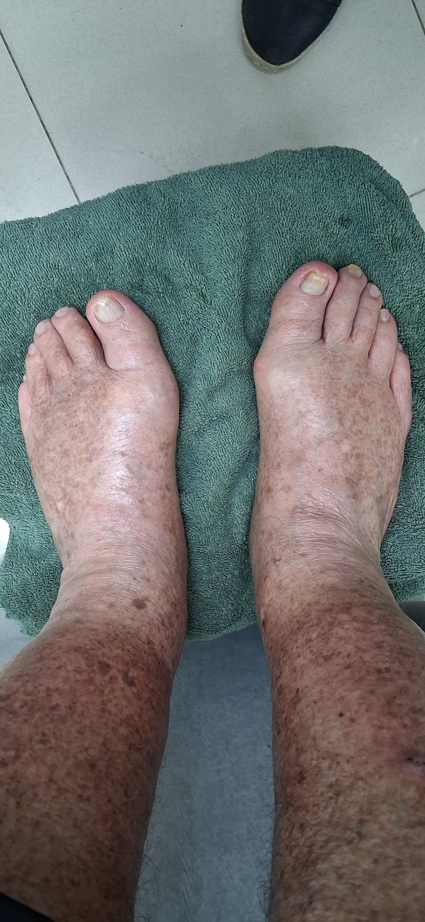 After: Cuidado de los pies