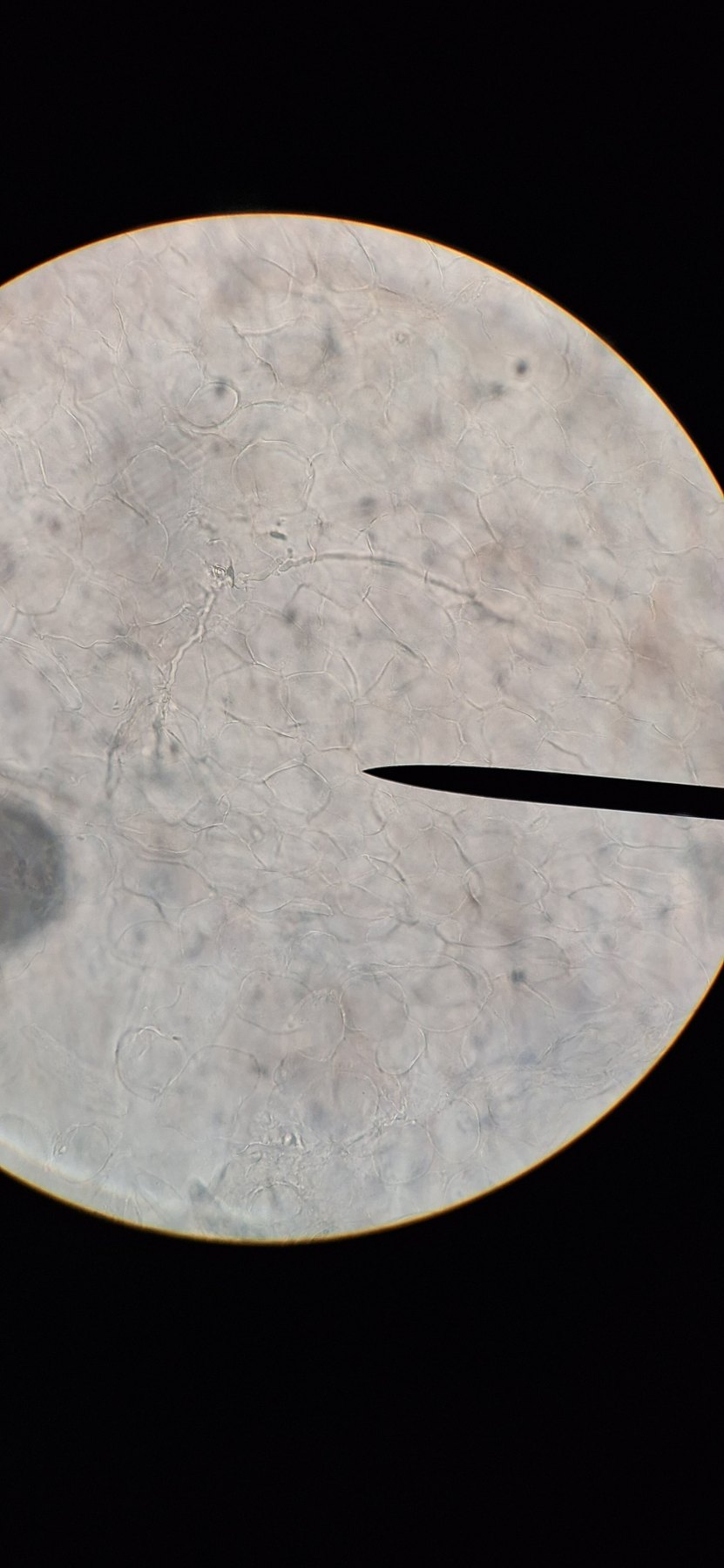 Microscope image: Onicomicosis del pie