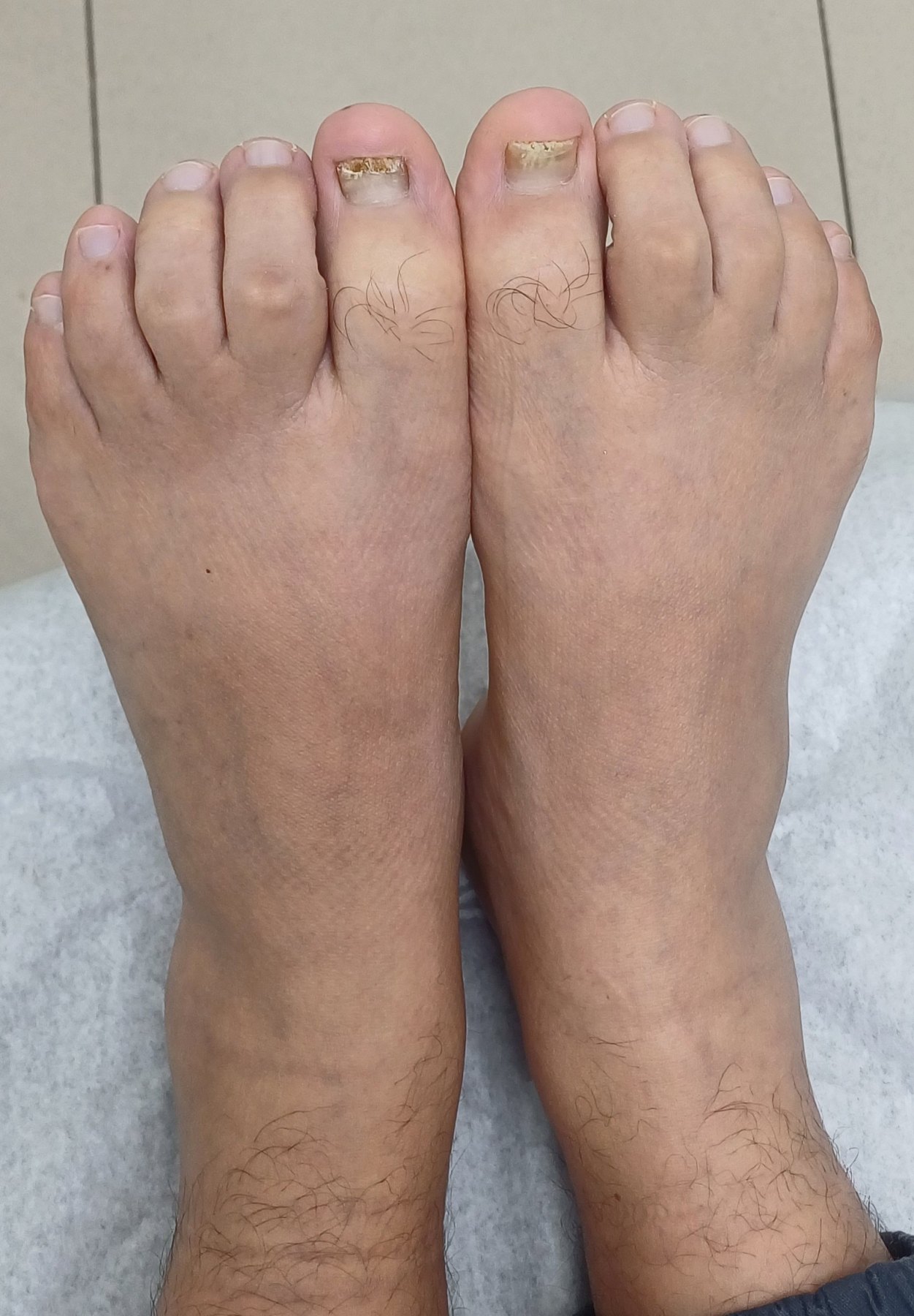 Before: Onicomicosis del pie
