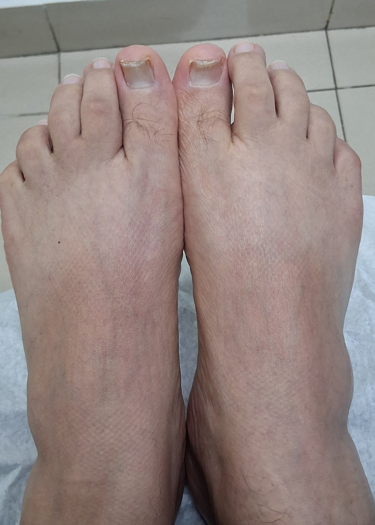 After: Onicomicosis del pie