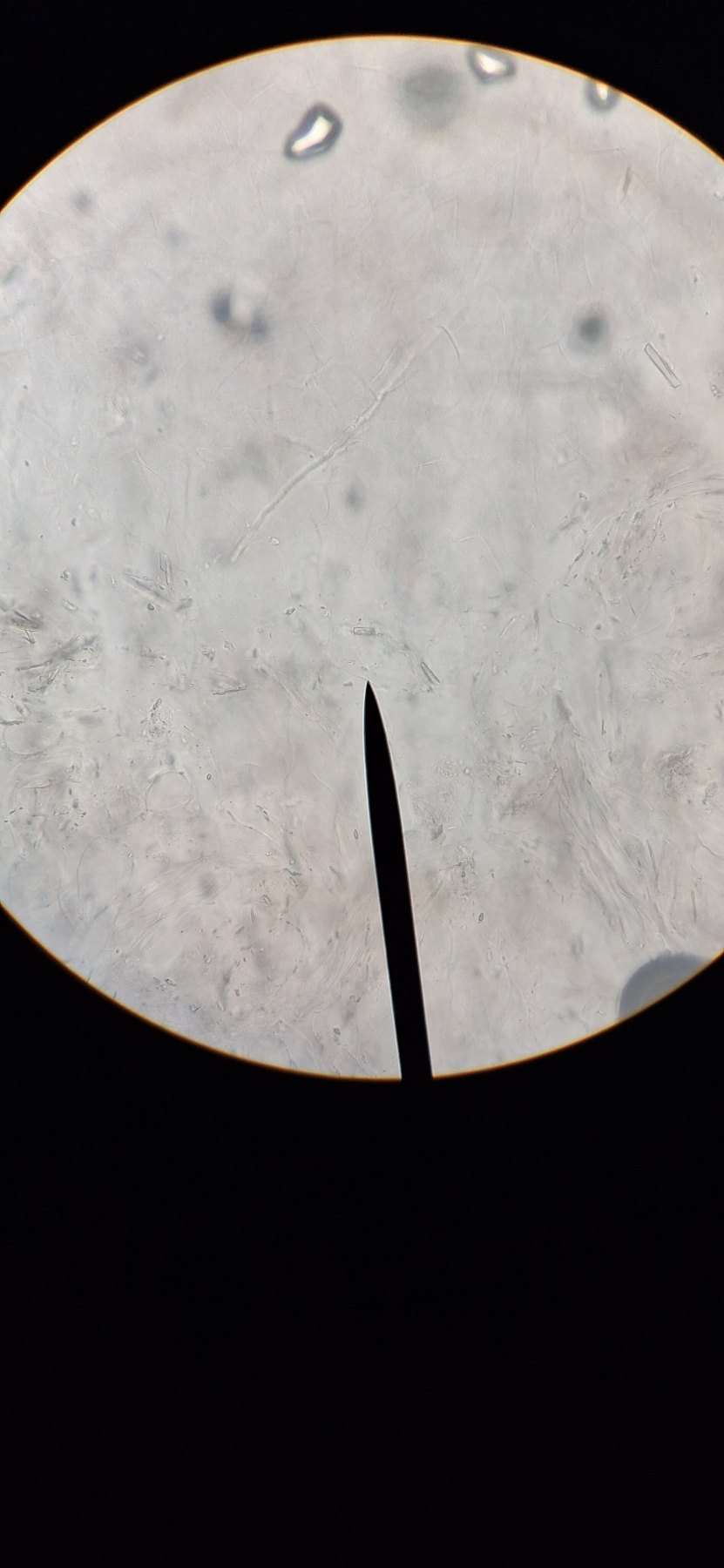 Onicomicosis del pie