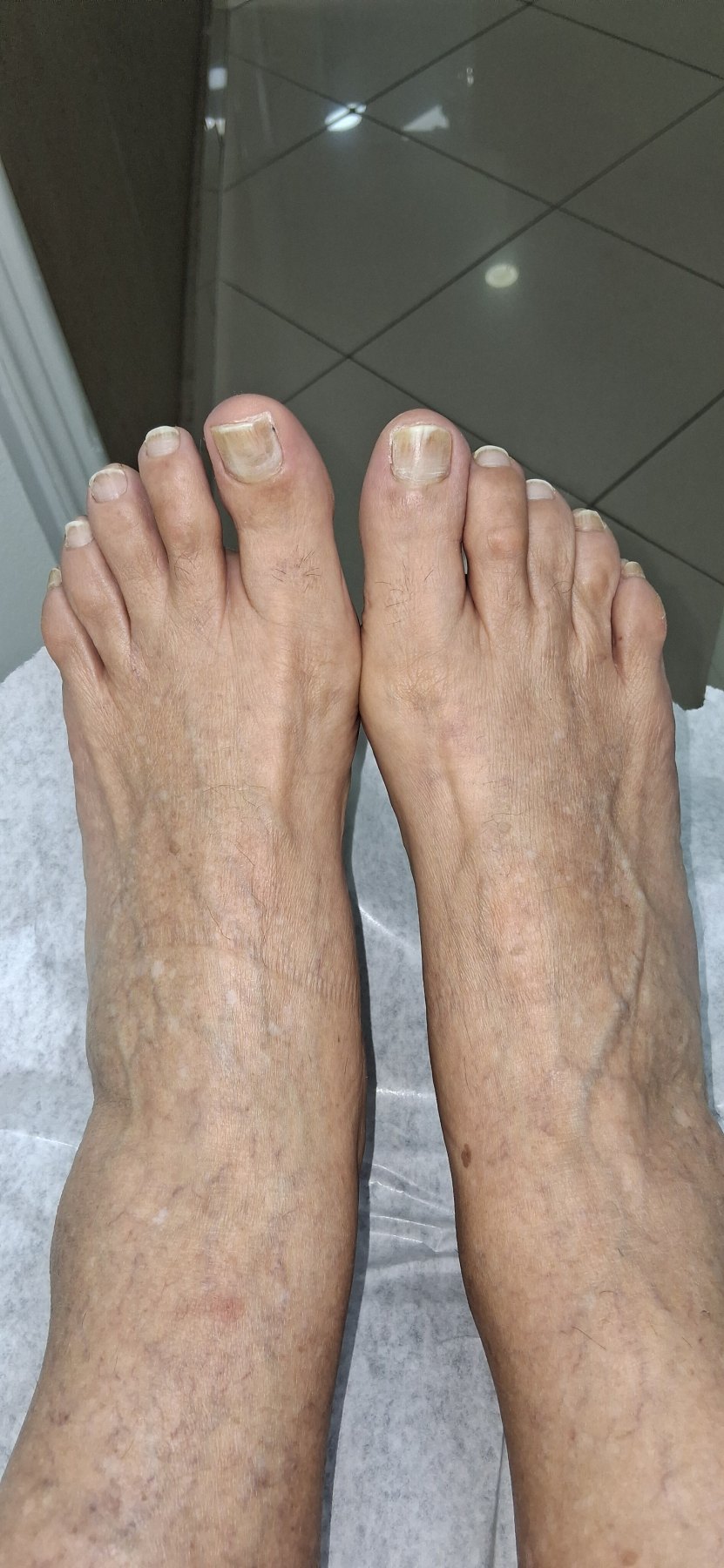 After: Onicomicosis del pie